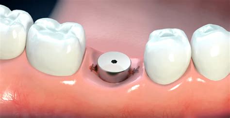 Benefits Of Dental Implant Healing Cap Restore Dental Implants