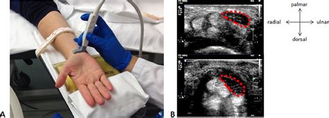 Automated Segmentation Of The Median Nerve In The Carpal Tunnel Using U