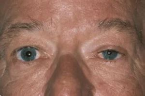 Traumatic Horner Syndrome Eyewiki