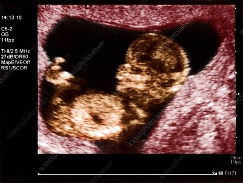 Ultrasound Of Foetus At 12 Weeks Stock Image P6800742 Science
