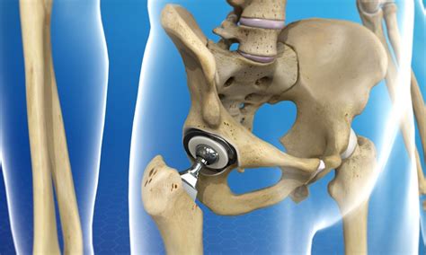 Surgical Options Total Hip Replacement Proliance Orthopedic