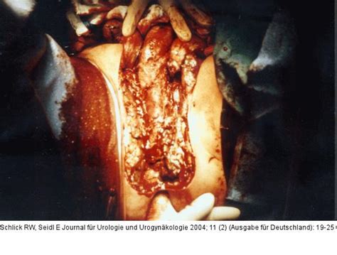 Die fourniersche gangrän ist eine foudroyant verlaufende nekrotisierende weichteilinfektion. Abbildung 5: Fourniersche Gangrän
