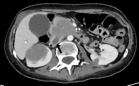 Bland Venous Thrombus Axial Contrast Enhanced Ct Image Of The Abdomen