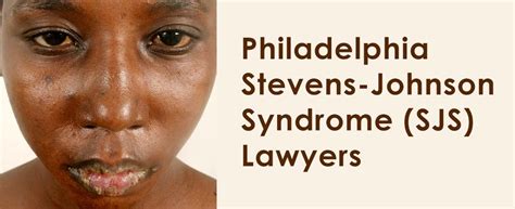 Philadelphia Stevens Johnson Syndrome Sjs Lawyers 2155462604