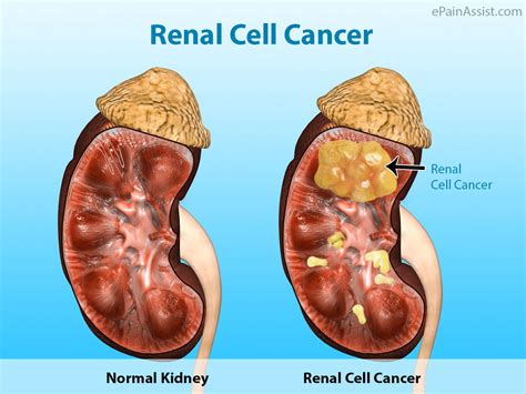 Blood in the urine, pain in the back that is continual, weight loss that is unexplained, extreme tiredness and painful or frequent urination. Renal Cell Cancer: Treatment, Complications, Prognosis