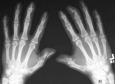 Learningradiology Psoriatic Arthritis Spondylitis