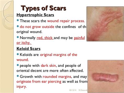 Hypertrophic Scars Causes Symptoms Diagnosis Treatment Health Rxharun