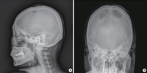 Figure 1 From Multifocal Osteosarcoma Of The Skull Multiple Primary Or