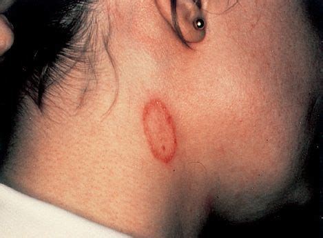 Cutaneous Subcutaneous Mycoses Basicmedical Key