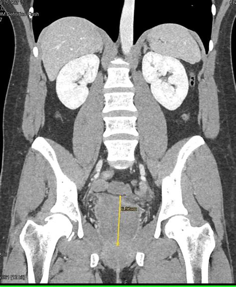 Enlarged Prostate Gland Genitourinary Case Studies Ctisus Ct Scanning