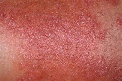 Pustular Psoriasis Symptoms Pictures Symptoms And Pictures
