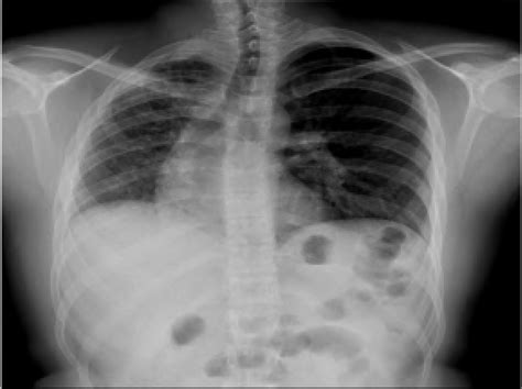 Pa Chest X Ray Film Showing A Small Right Hemithorax With A Small Right