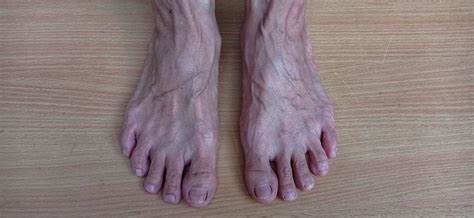 Bulging Veins On Feet Doctor Vein