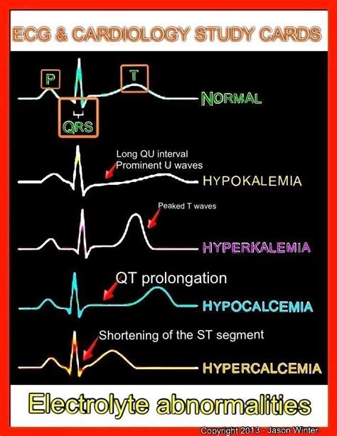 EKG Changes With Electrolyte Abnormalities Nursing Mnemonics Cardiology Study Nclex