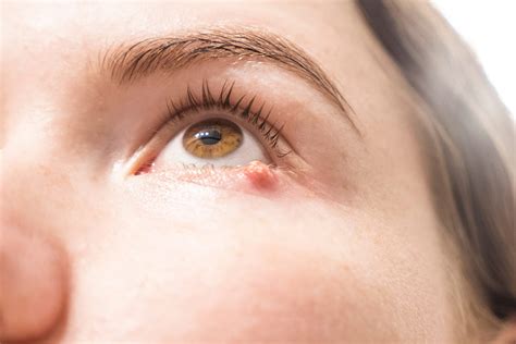 What Causes Styes And How To Get Rid Of Them Banner Health