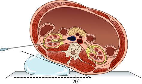 Modified Supine Percutaneous Nephrolithotomy For Large Kidney And