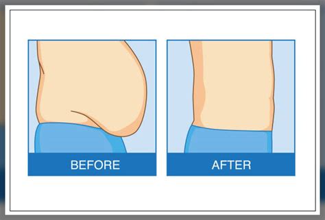 Too Much Belly Fat What Is The Best Procedure Repc