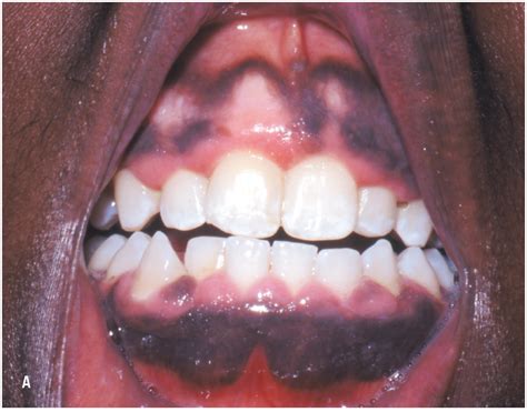 A Gallery Of Pigmentation Disorders Consultant360
