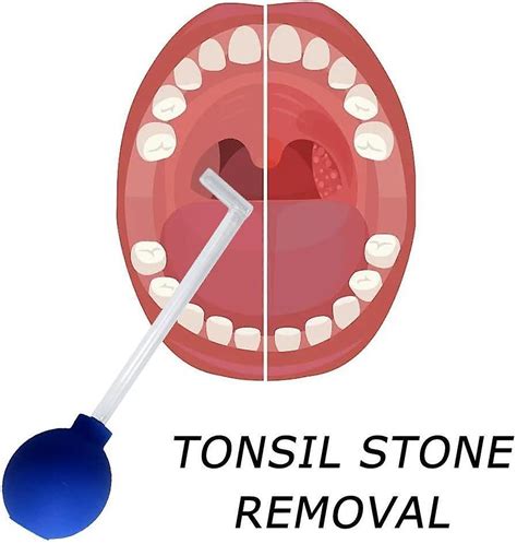 Tonsil Stone Remover Vacuum Tonsil Stone Removal Kit Tool Tonsil Stone