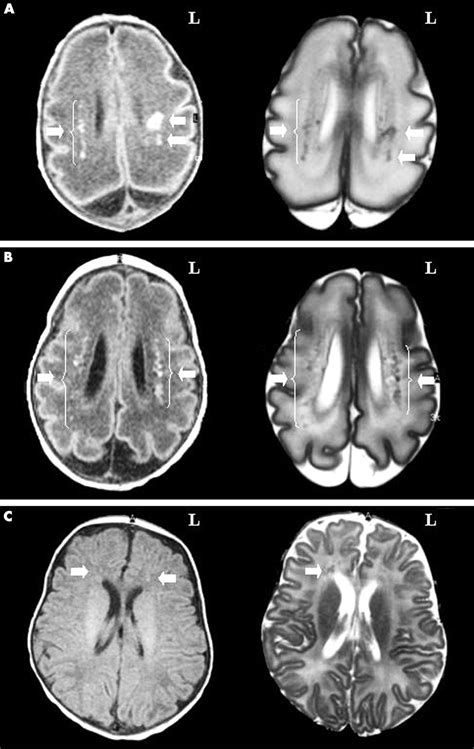 Magnetic Resonance Imaging Of The Infant Brain Anatomical