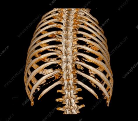 Rib Cage 3d Ct Scan Stock Image C0527554 Science Photo Library
