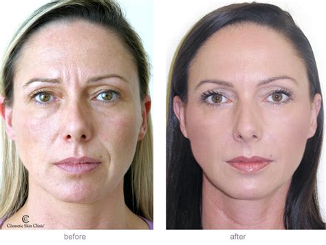 Dermal Fillers Before And After Gallery