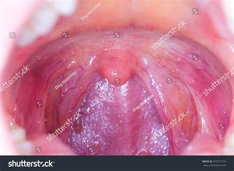 Tonsilitis Infection Throatmacro Opened Mouth Throat Stock Photo