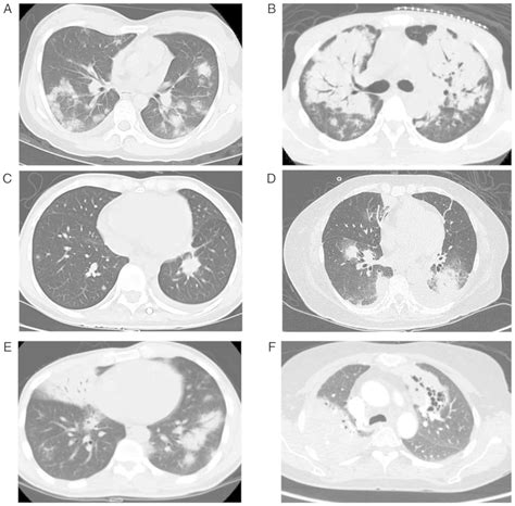 Diagnostic And Prognostic Factors For Patients With Primary Pulmonary
