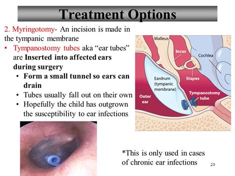 Though the two are similarly pampering, it helps to understand the basic differences. What is the difference between a myringotomy and ...