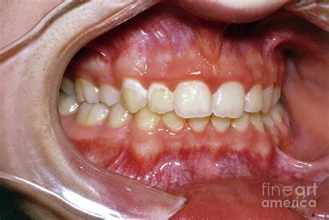 Close Up Of Teeth After Removal Of Fixed Braces Photograph By Jane Shemilt Science Photo Library