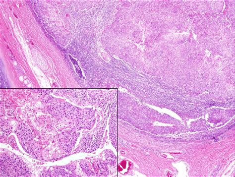 Microscopic Finding Showed Metastatic Squamous Cell Carcinoma To The