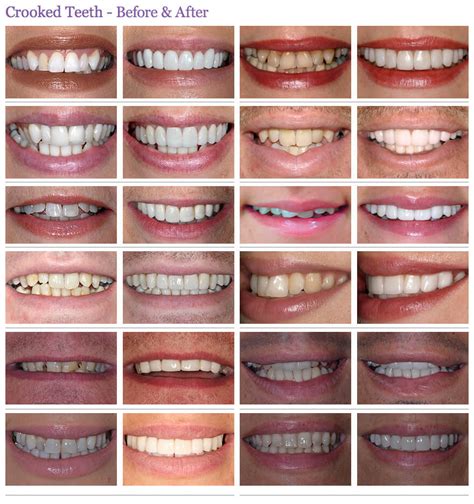 Crooked Or Crowding Teeth Treatment Before And After Photos The Perfect