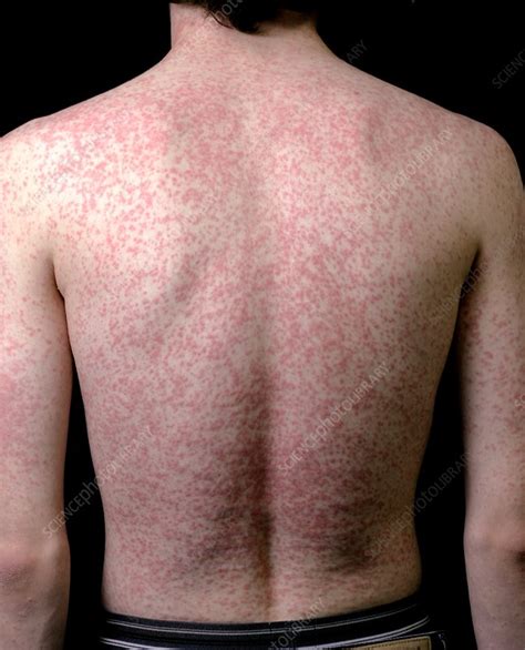 Body Rash Caused By Antibiotic Drug Stock Image C015 6133 Science Photo Library