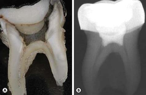 Lower Primary Molar Extracted 30 Months After The Pulpotomy Treatment