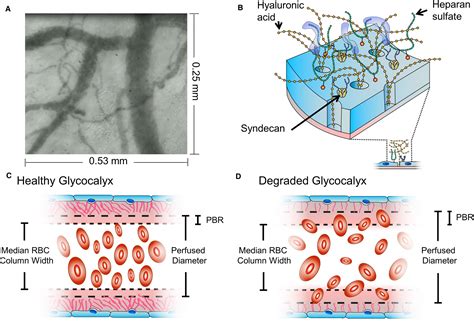 Early Onset Preeclampsia Is Associated With Glycocalyx Degradation And