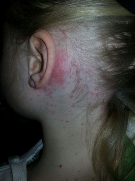 Rash Behind Ear Pictures Causes And Treatment