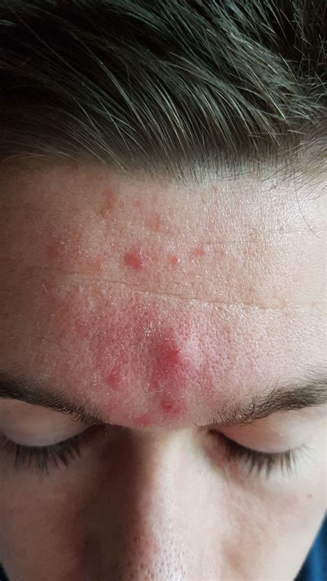 Please Help 5 Years And Still Dont Know What This Is Adult Acne