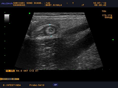 Shrivari Sono Scans Ultrasonography For The Diagnosis Of Appendicitis