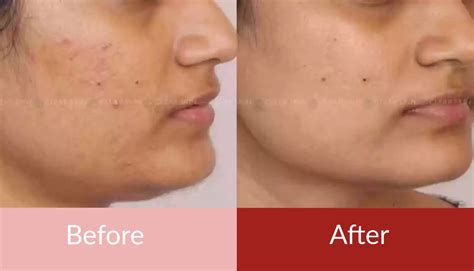 Acne Scar Treatment Results Before And After Pictures