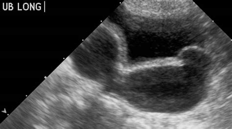 Ureterocele - wikidoc