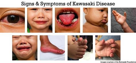Kawasaki Disease In Infants And Young Children