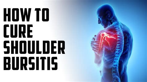 How To Cure Shoulder Bursitis A Episode Youtube
