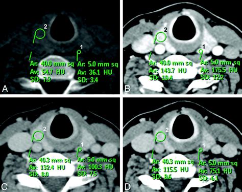 Dual Energy 4 Phase Ct Scan In Primary Hyperparathyroidism Ajnr Blog