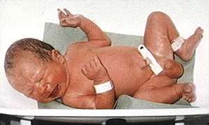 Baby Circumcision Infection