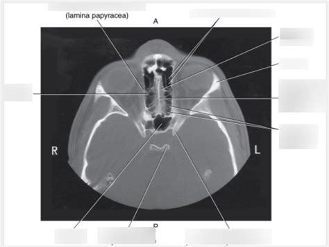 Axial Ct Of Ethmoid Bone Diagram Quizlet