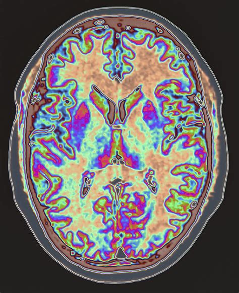 Mri Brain White Spots Cause Mri Scan Images Mri Scans Sexiz Pix