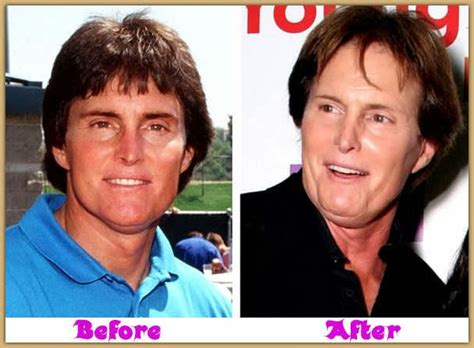Bruce Jenner Plastic Surgery Before And After Facelift Skin Cancel