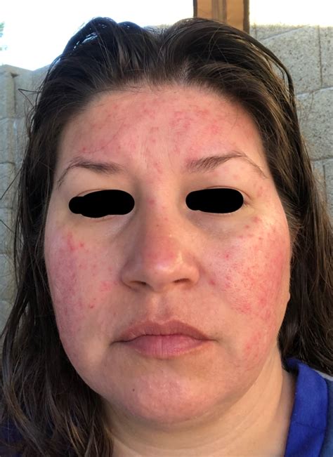 Face Rash Tingles Stings Itches Burns With Photos Dermatology