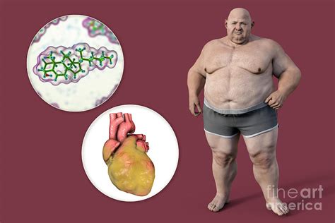 Cholesterol And Fatty Heart In Overweight Man Photograph By Kateryna