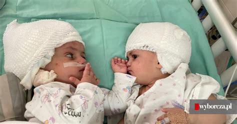 izrael udana operacja rozdzielenia syjamskich bliźniąt dziewczynki po raz pierwszy spojrzały